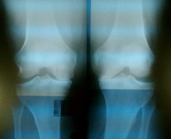 My Knee X-Rays